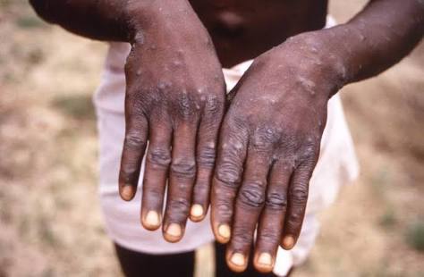 Suspected cases of monkey pox in Nigeria spread to 11 states – Minister